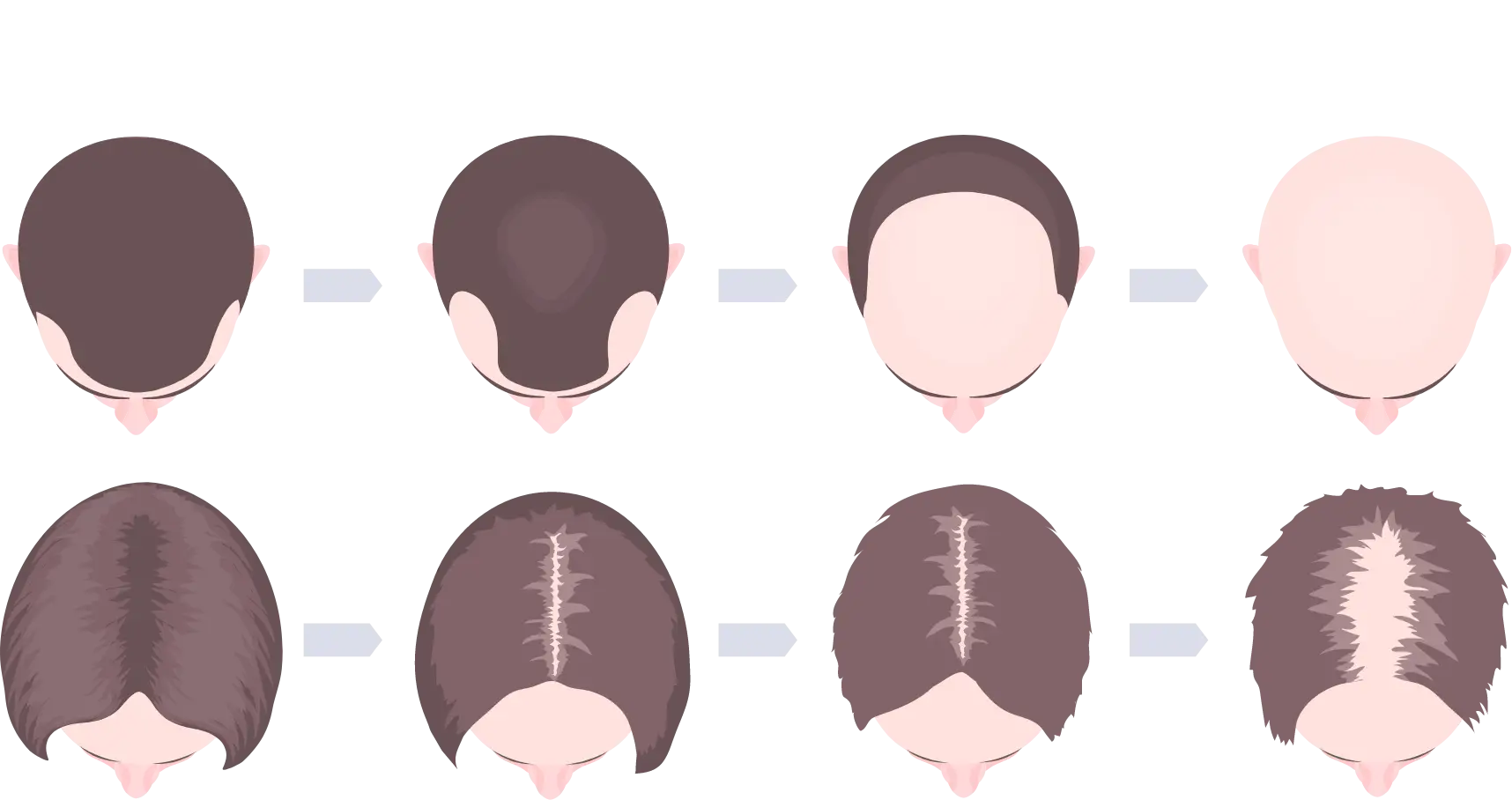Hairloss and Hairfall Treatment in Miami
